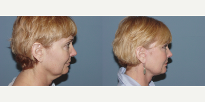 Facelift before and after photo