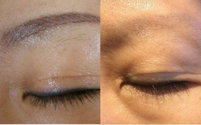PicoSure before and after photo