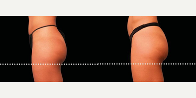 Emsculpt before and after photo