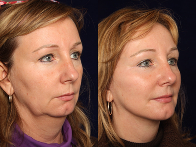 Facelift before and after photo
