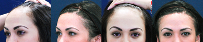 Forehead Reduction before and after photo