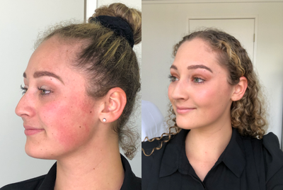 IPL before and after photo