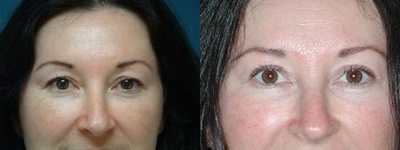 Eyelid Surgery before and after photo