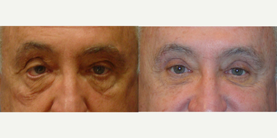 Eyelid Surgery before and after photo