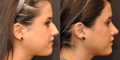 Rhinoplasty before and after photo