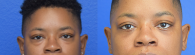 Eyelid Surgery before and after photo