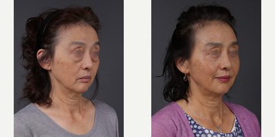 Eyelid Surgery before and after photo