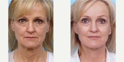 Facial Fat Transfer before and after photo