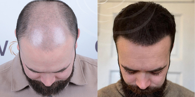 FUE Hair Transplant before and after photo