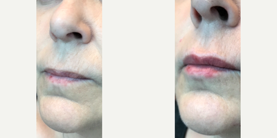 Juvederm before and after photo