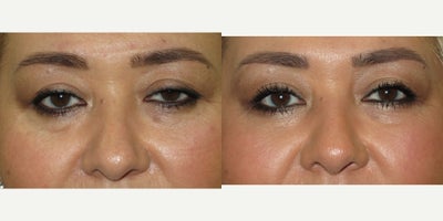 Ptosis Surgery before and after photo