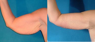 Arm Lift before and after photo