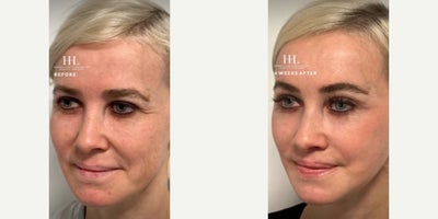 Brow Lift before and after photo