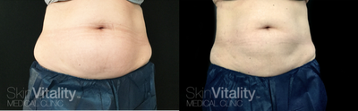 CoolSculpting before and after photo