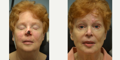 Facial Reconstructive Surgery before and after photo