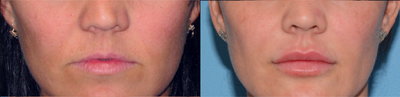 Juvederm before and after photo