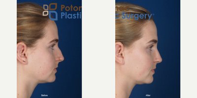 Rhinoplasty before and after photo