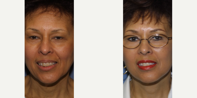 Breast Lift before and after photo