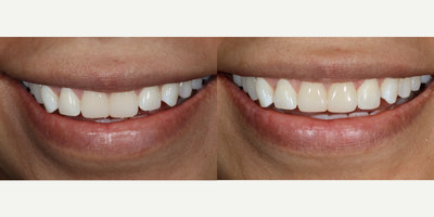 Dental Bonding before and after photo