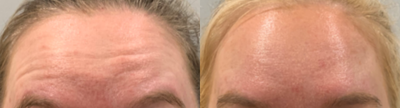 Dysport before and after photo