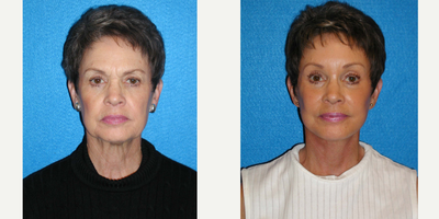 Facelift before and after photo
