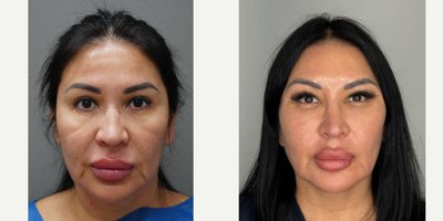 Facelift before and after photo