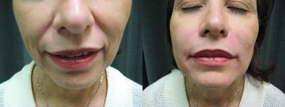 Juvederm before and after photo