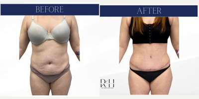 Liposuction before and after photo
