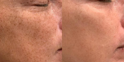 Chemical Peel before and after photo