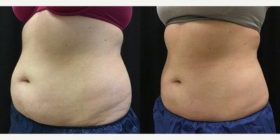 CoolSculpting before and after photo
