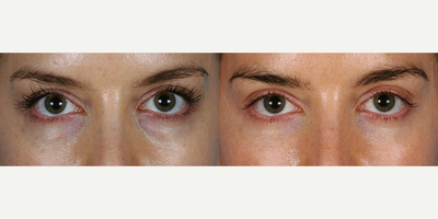 Eyelid Surgery before and after photo