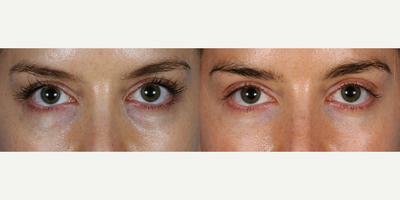 Eyelid Surgery before and after photo