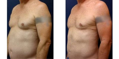 Liposuction Revision before and after photo