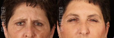 Botox before and after photo