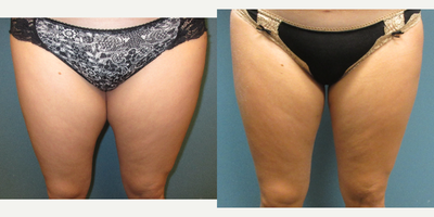 Liposuction before and after photo