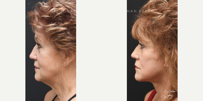 Neck Lift before and after photo