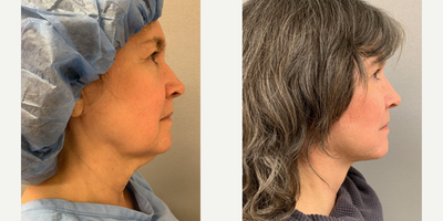 SMAS Facelift before and after photo