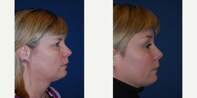 Brow Lift before and after photo
