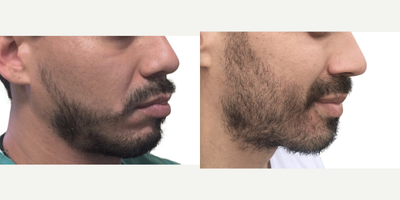 FUE Hair Transplant before and after photo