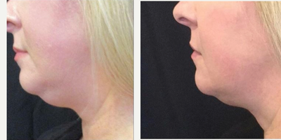 Kybella before and after photo