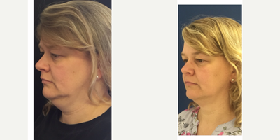 CoolSculpting before and after photo
