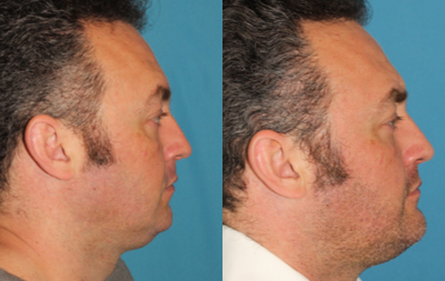 Genioplasty before and after photo