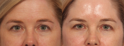 Restylane before and after photo
