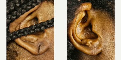 Earlobe Repair before and after photo
