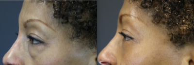 Eyelid Surgery before and after photo