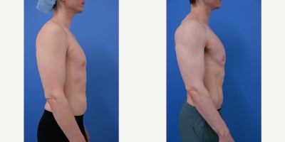 Pec Implants before and after photo