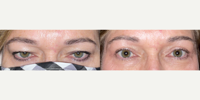 Ptosis Surgery before and after photo