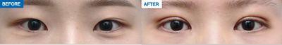 Canthoplasty before and after photo