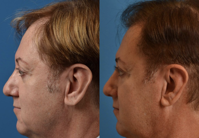 NeoGraft before and after photo