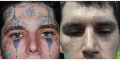 Tattoo Removal before and after photo